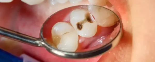 caries dentaires